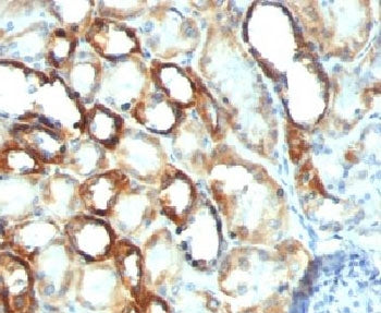 IHC testing of FFPE human renal cell carcinoma with Mitochondria marker antibody.