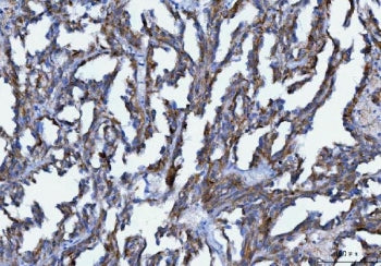 IHC staining of FFPE human renal carcinoma tissue with AXIN2 antibody. HIER: boil tissue sections in