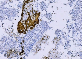 IHC staining of FFPE human lung cancer tissue with CD61 antibody. HIER: boil tissue sections in pH8