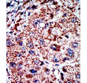 IHC staining of FFPE human cancer tissue with PFKL antibody. HIER: steam section in pH6 citrate buff