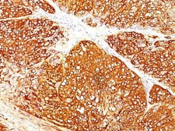 IHC staining of FFPE human melanoma with Melanoma Marker antibody cocktail (A103 + T311 + HMB45). HI