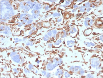 IHC staining of FFPE human colon carcinoma with Vimentin antibody (clone VIM/3736). HIER: boil tissu