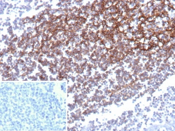 IHC staining of FFPE human prostate carcinoma with CD35 antibody (clone CD35/9444). Inset: PBS used