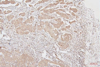 IHC staining of FFPE human breast cancer with HMGB1 antibody. HIER: boil tissue sections in pH6, 10m