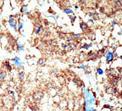 IHC testing of FFPE human breast cancer tissue with Eph Receptor B1 antibody. HIER: steam section in