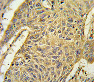 IHC staining of FFPE human lung carcinoma tissue with AGER antibody. HIER: steam section in pH6 citr