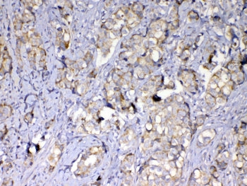 IHC testing of FFPE human breast cancer tissue with MMP10 antibody at 1ug/ml. Required HIER: steam s