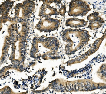 IHC staining of FFPE human rectal cancer with DNAJA2 antibody. HIER: boil tissue sections in pH8 EDT