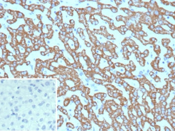 IHC staining of FFPE human hepatocellular carcinoma tissue with Carbamoyl phosphate synthetase 1 ant