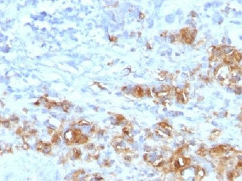 IHC testing of FFPE human gastric carcinoma with recombinant CA19-9 antibody (clone CA19.9/1390R). H
