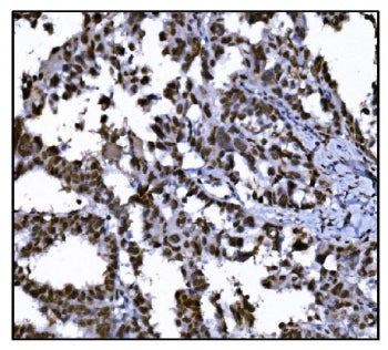 IHC staining of FFPE human ovarian cancer tissue with HDAC2 antibody. HIER: boil tissue sections in
