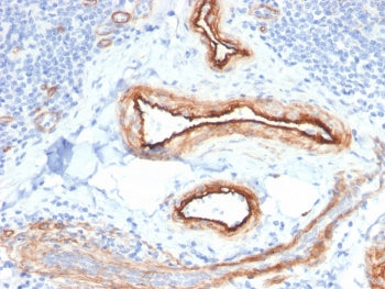 IHC staining of FFPE human renal cell carcinoma with MTF1 antibody. HIER: boil tissue sections in pH