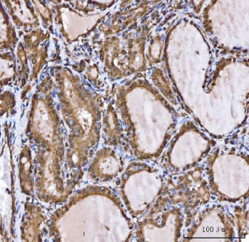 IHC staining of FFPE human thyroid cancer tissue with XIAP associated factor 1 antibody. HIER: boil