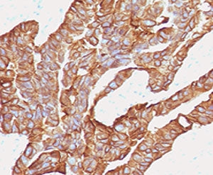 IHC testing of human colorectal carcinoma with anti-EpCAM antibody (clone EPM17-2). Staining of FFPE