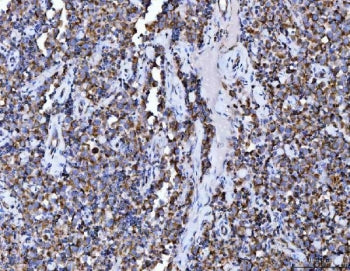 IHC staining of FFPE human testicular germ cell tumor tissue with ACO2 antibody. HIER: boil tissue s