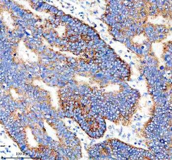 Immunohistochemical staining of IER3 using anti-IER3 antibody. IER3 was detected in a paraffin-embed
