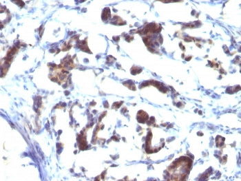IHC staining of FFPE human gastric carcinoma with ZFYVE28 antibody (clone LST2/2426). HIER: boil tis