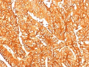 IHC testing of FFPE human colon carcinoma and recombinant Ep-CAM antibody (clone EGP40/1556R). Requi