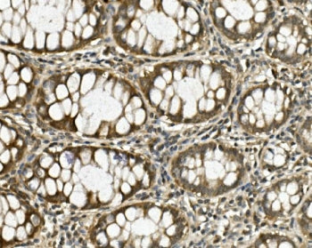 IHC staining of FFPE human rectal cancer with HGS antibody. HIER: boil tissue sections in pH8 EDTA f