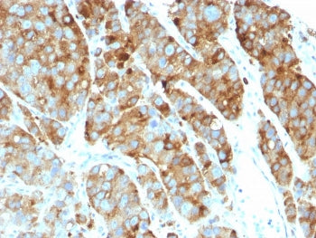 IHC: Formalin-fixed, paraffin-embedded human prostate carcinoma stained with CD63 / LAMP-3 antibody