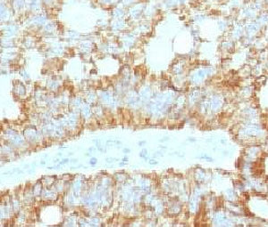 IHC staining of FFPE human colon carcinoma with ICOS Ligand antibody (clone ISLG-1). HIER: boil tiss