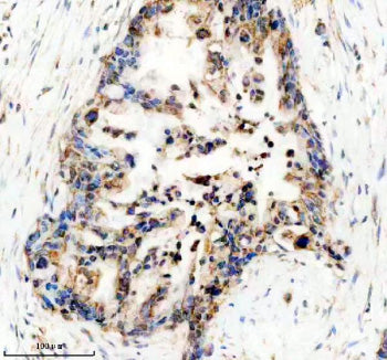 Immunohistochemical staining of UBE2W using anti-UBE2W antibody. UBE2W was detected in a paraffin-em