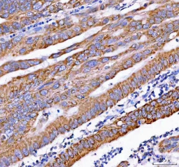 IHC staining of FFPE human rectum adenocarcinoma tissue with PDK3 antibody. HIER: boil tissue sectio