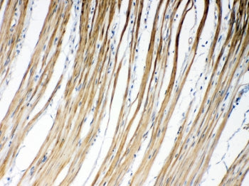 IHC testing of FFPE human intestinal cancer tissue with GJC1 antibody at 1ug/ml. Required HIER: stea