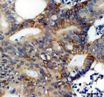IHC staining of FFPE human colon cancer tissue with Perilipin 3 antibody, HRP-secondary and DAB subs