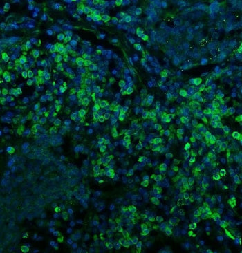 Immunofluorescent staining of FFPE human lung cancer with CD74 antibody (green) and DAPI nuclear sta