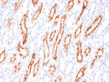 IHC staining of FFPE human renal cell carcinoma with CD137L antibody. HIER: boil tissue sections in