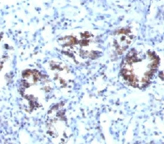 IHC: Formalin-fixed, paraffin-embedded human colon carcinoma stained with Transgelin antibody (SPM60