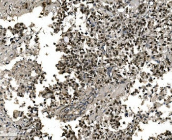 IHC staining of FFPE human gastric cancer tissue with FOXA2 antibody. HIER: boil tissue sections in
