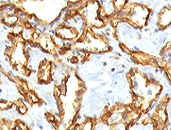IHC staining of FFPE human angiocarcinoma with recombinant CD31 antibody (clone RMCD31-1). HIER: ste