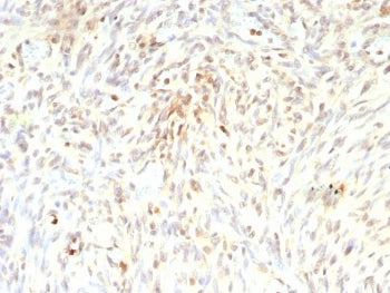 IHC staining of FFPE human liposarcoma tissue with recombinant MDM2 antibody (clone rMDM2/9214). HIE
