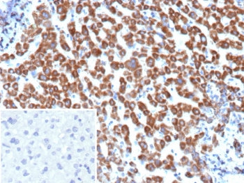 IHC staining of FFPE human hepatocellular carcinoma tissue with Angiopoietin 1 antibody (clone ANGPT