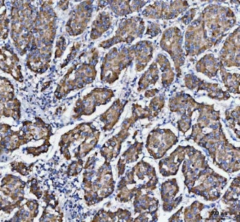 IHC staining of FFPE human liver cancer tissue with DAPK1 antibody. HIER: boil tissue sections in pH