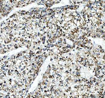 Immunohistochemical staining of FFPE human liver cancer tissue with ALDH2 antibody, HRP-secondary an