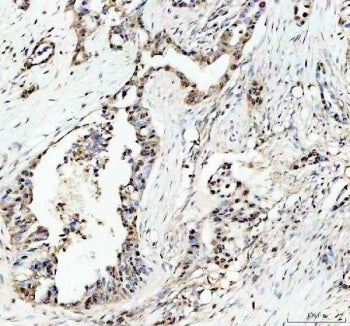 IHC staining of FFPE human pancreas cancer tissue with c-Myb antibody. HIER: boil tissue sections in