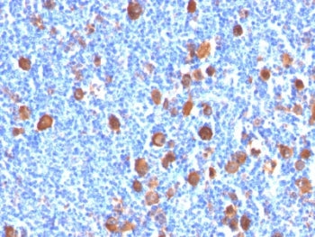 IHC: Formalin-fixed, paraffin-embedded human Hodgkin's lymphoma stained with Fascin antibody (FSCN1/