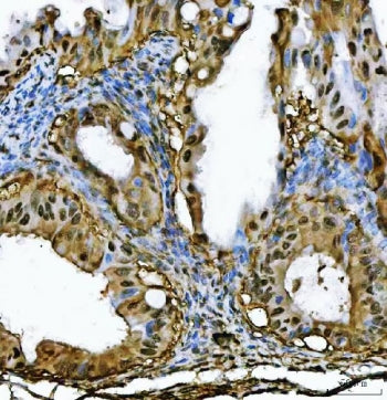 IHC staining of FFPE human ovarian cancer tissue with PSMB4 antibody. HIER: boil tissue sections in