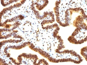 IHC: Formalin-fixed, paraffin-embedded human ovarian carcinoma stained with SUMO-1 antibody (SUMO1/1