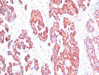 IHC staining of FFPE human breast carcinoma with Basic Cytokeratin antibody (clone SPM116). HIER: bo