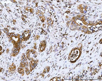 IHC testing of FFPE differentiated adenocarcinoma in human appendix tissue with COX-2 antibody. HIER
