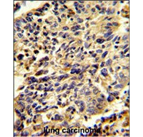 IHC staining of FFPE human lung carcinoma tissue with Glypican-1 antibody. HIER: steam section in pH