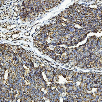 IHC staining of FFPE human urothelial carcinoma tissue with CXCR7 antibody. HIER: boil tissue sectio
