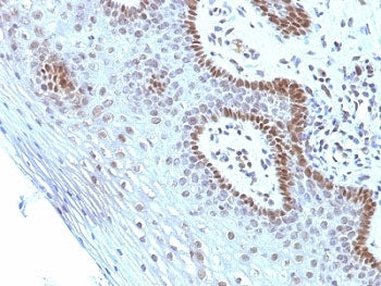 IHC analysis of formalin-fixed, paraffin-embedded human cervical carcinoma stained with Myc antibody