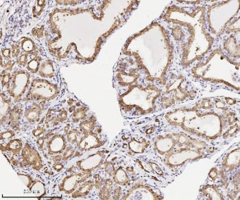 IHC staining of FFPE human thyroid cancer tissue with ANXA3 antibody. HIER: boil tissue sections in