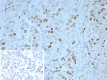 IHC staining of FFPE human ovarian carcinoma tissue with PAX4 antibody (clone PAX4/7598). Inset: PBS