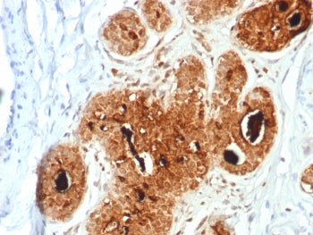 IHC staining of FFPE human breast carcinoma tissue with Prolactin-Induced Protein antibody (clone PI